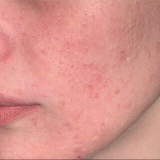 The same client's cheek after three weeks of acne treatment