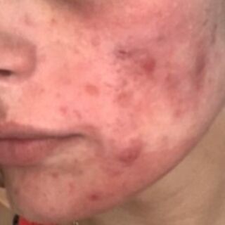 Client's cheek before acne treatment at New Face New Body in Canton, MI